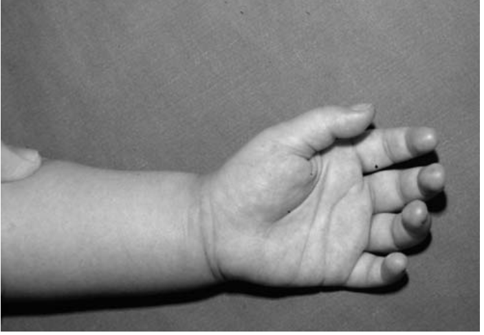Revista Brasileira de Ortopedia - Tratamento do Dedo em Gatilho